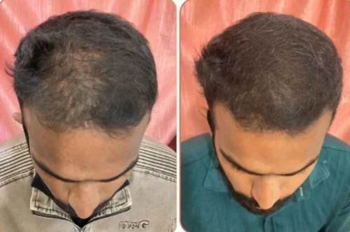 Click to view full screen Complete Hair Combo-With Shampoo(Rubodex Hair Oil,Herbal Shampoo Forte Tablets) photo review