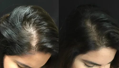Click to view full screen Complete Hair Combo-With Shampoo(Rubodex Hair Oil,Herbal Shampoo Forte Tablets) photo review
