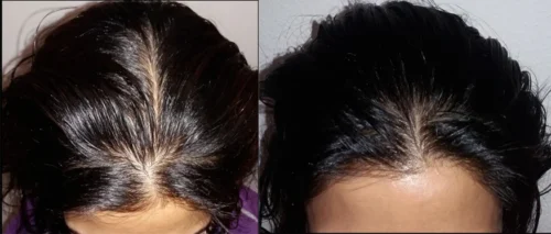 Click to view full screen Complete Hair Combo-With Shampoo(Rubodex Hair Oil,Herbal Shampoo Forte Tablets) photo review