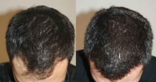 Click to view full screen Complete Hair Combo-With Shampoo(Rubodex Hair Oil,Herbal Shampoo Forte Tablets) photo review