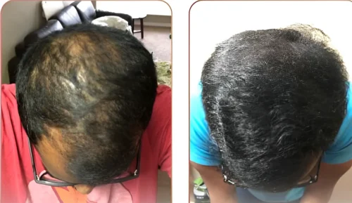 Click to view full screen Complete Hair Combo-With Shampoo(Rubodex Hair Oil,Herbal Shampoo Forte Tablets) photo review